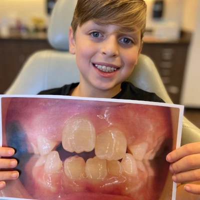 Children's Braces Before & After 2